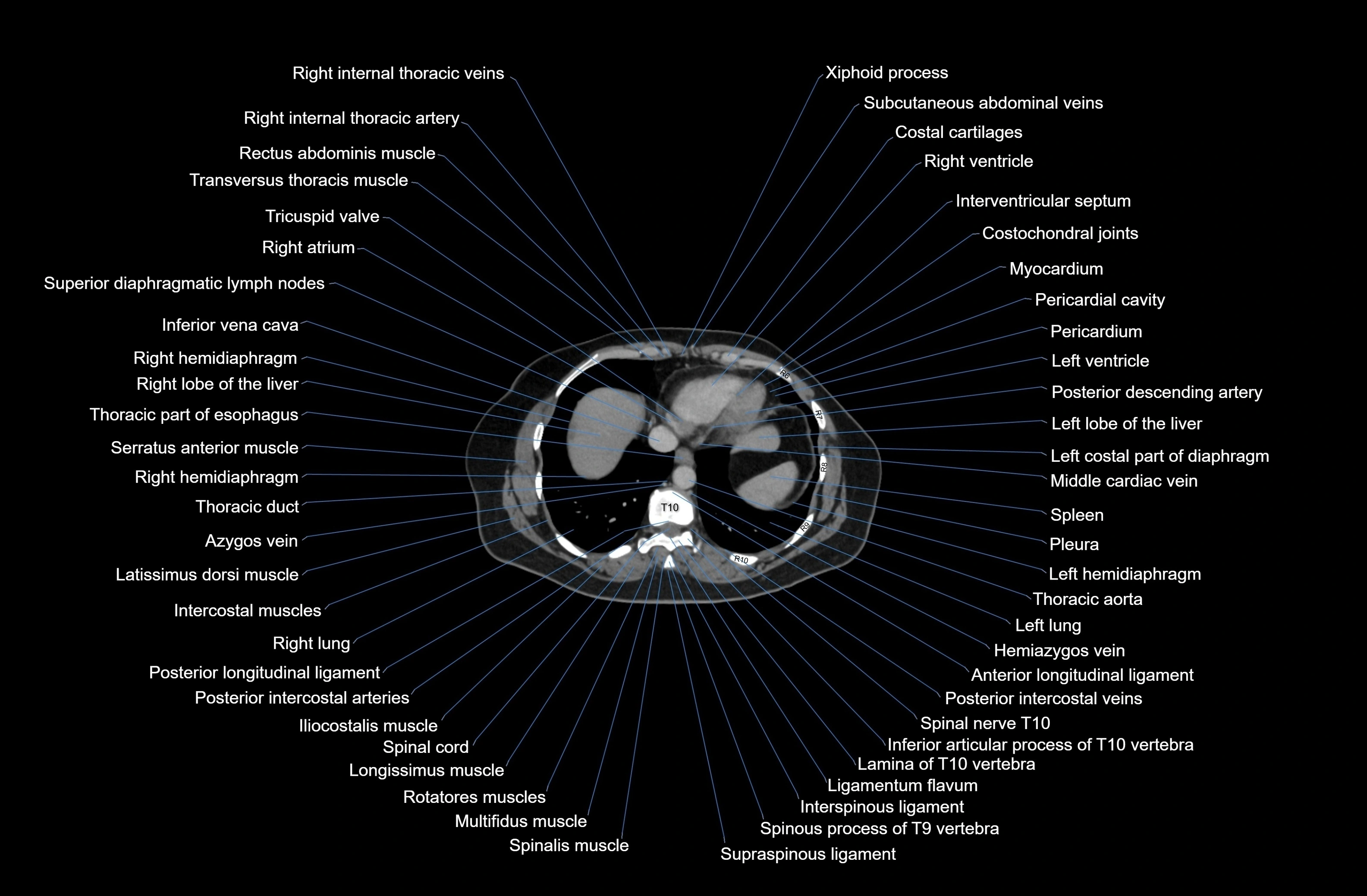 CT Abdomen axial cross sectional anatomy labelled radiology image-00007.webp